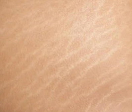 Prevenir las estrías durante el embarazo